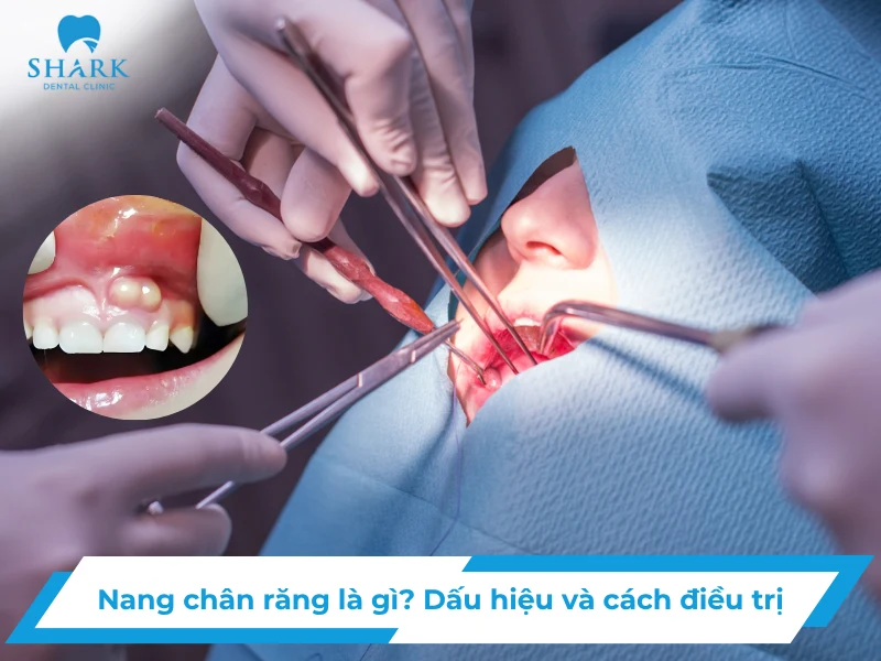 dấu hiệu nang chân răng và điều trị