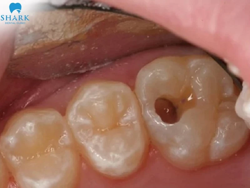 Nhét gì vào răng sâu để làm giảm cơn đau tạm thời? 11 Răng sâu gây ảnh hưởng tới chức năng ăn nhai và sinh hoạt hằng ngày