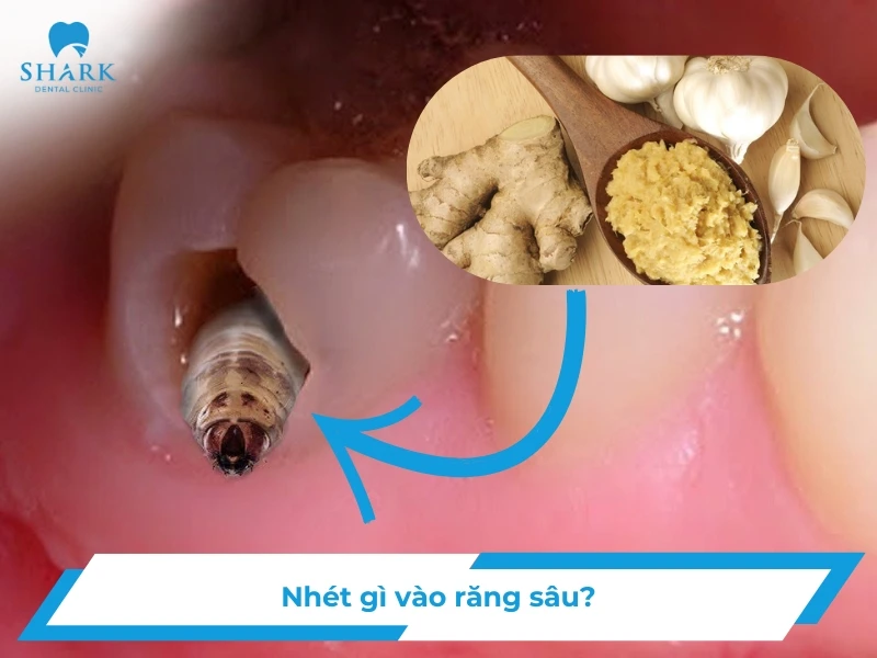 Nhét gì vào trong răng sâu