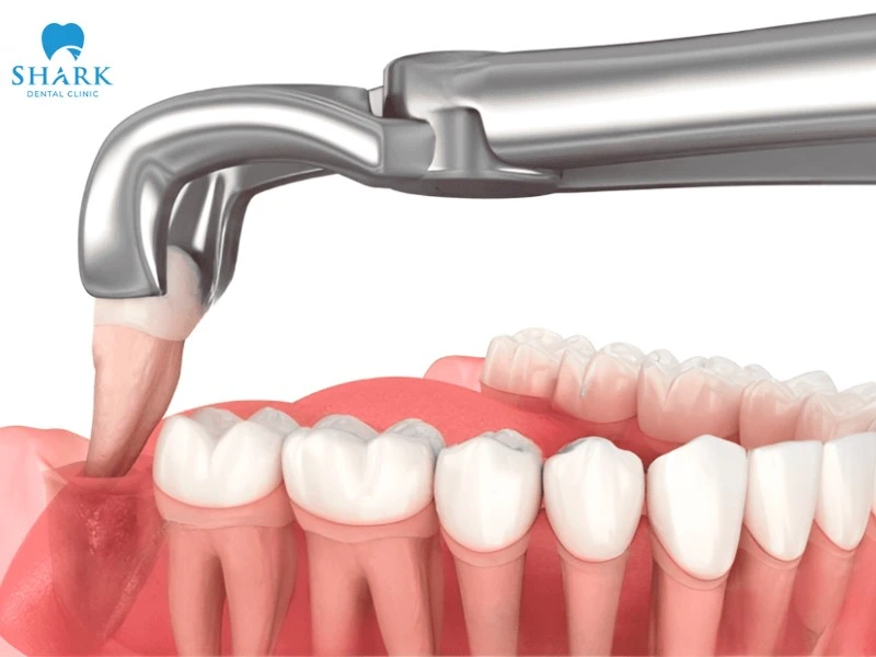 Nếu là răng vĩnh viễn, sau khi nhổ sẽ không thể mọc lại