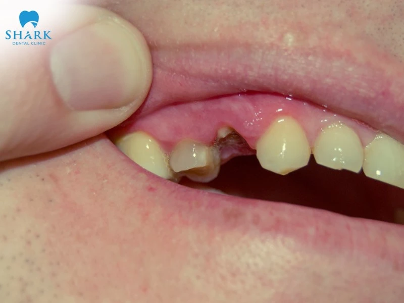 Răng bị sâu răng nghiêm trọng không thể phục hồi cần tiến hành nhổ bỏ