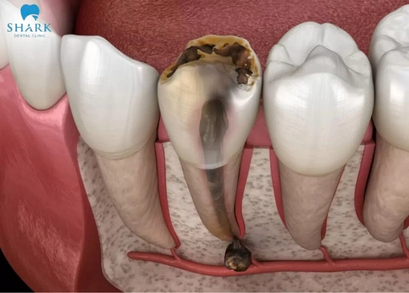 Răng đã chết tủy chỉ nên nhổ khi chúng không thể phục hồi chức năng ăn nhai và  ảnh hưởng nghiêm trọng đến các răng lân cận