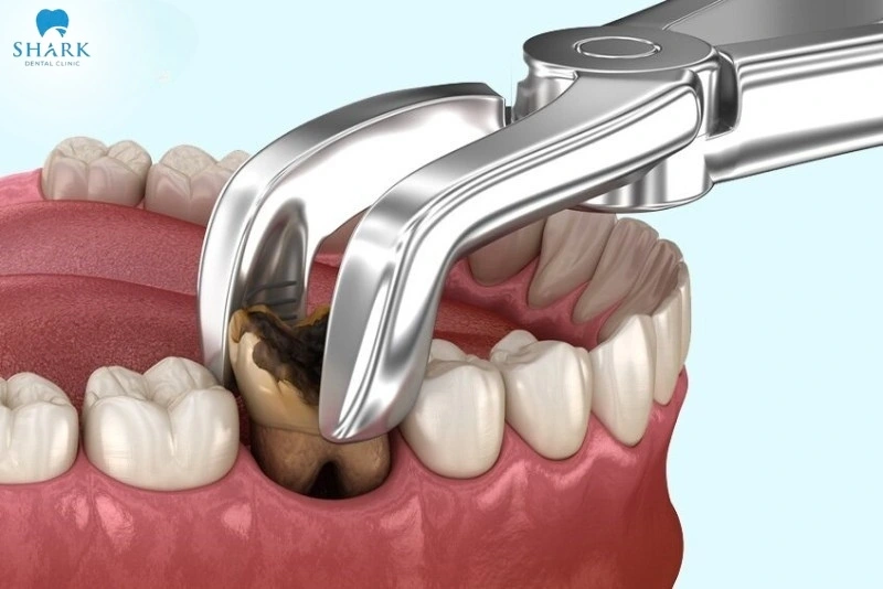Nhổ răng đã chết tủy có đau không? Bạn vẫn sẽ cảm thấy đau nhưng sẽ được kiểm soát tốt bằng thuốc tê trong quá trình thực hiện