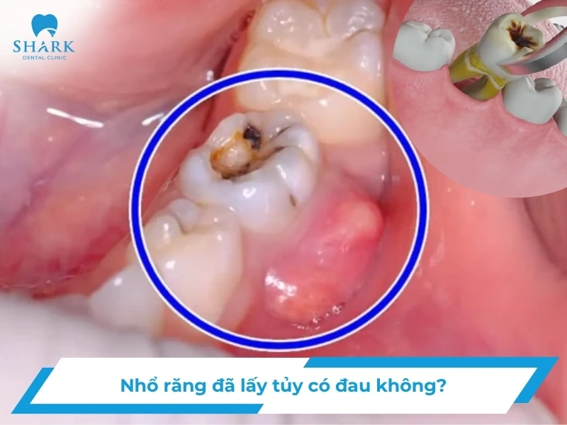 Nhổ răng đã lấy tủy có đau không