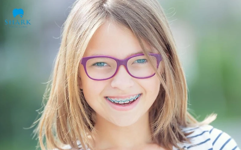 Niềng răng cho trẻ 8 tuổi có được không? Có lợi ích gì? 8 Niềng răng cho trẻ 8 tuổi