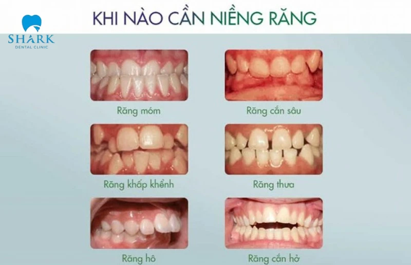 Niềng răng cho trẻ 8 tuổi có được không? Có lợi ích gì? 10 Trường hợp nên niềng răng cho trẻ 8 tuổi