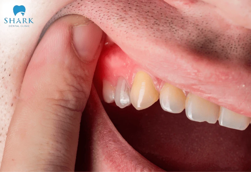 Áp xe nướu là dấu hiệu cần phải điều trị tủy răng sớm