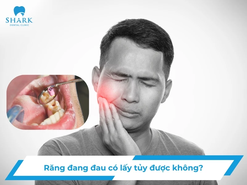 Răng đang đau có lấy tủy được không? Khi nào cần lấy sớm? 10 Răng đang đau có lấy tủy được không
