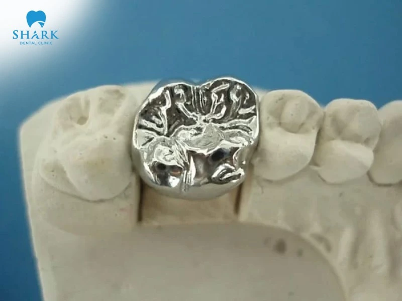 Răng Inox hỗ trợ bảo vệ răng thật và phục hồi chức năng ăn nhai tốt