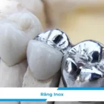 Răng Inox