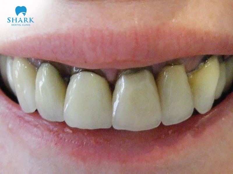 Răng Inox bị đen viền nướu có thể do vệ sinh răng miệng chưa đúng cách