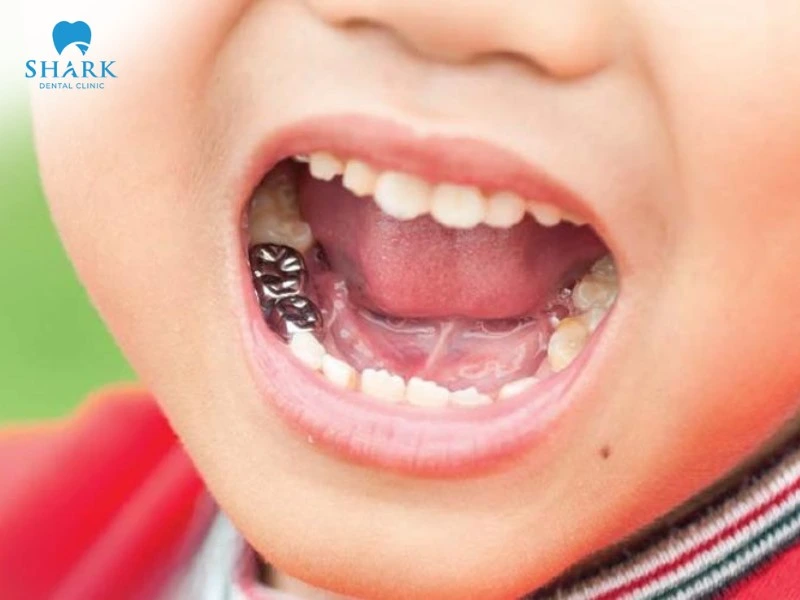 Bọc răng Inox cho bé giúp bảo vệ và giữ răng sữa cho đến khi răng vĩnh viễn mọc lên