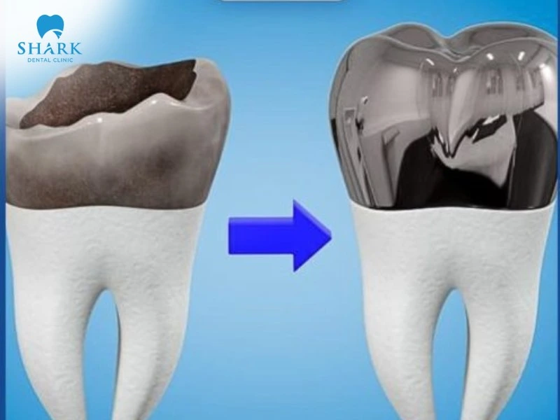 Chi phí bọc răng Inox còn phụ thuộc vào nhiều yếu tố khác nhau