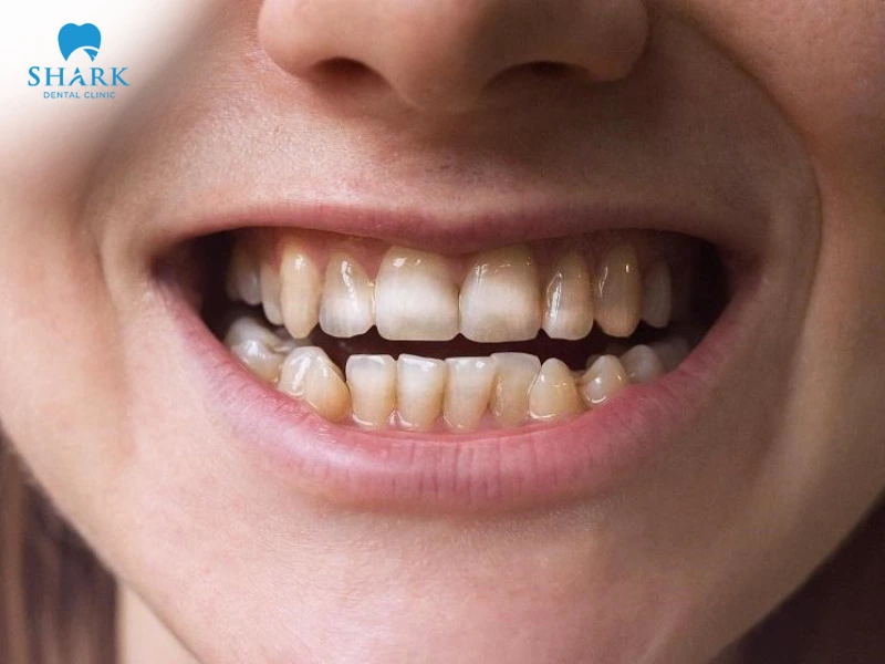 Răng nhiễm Fluor gây ảnh hưởng đến màu sắc và cấu trúc men răng, khiến bề bề mặt răng xuất hiện các đốm trắng hoặc nâu