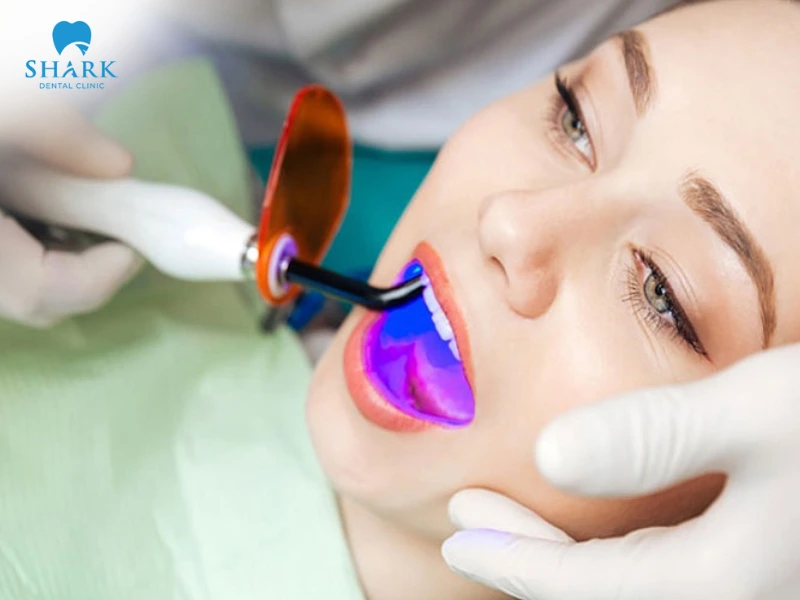 Sử dụng thuốc tẩy trắng kết hợp công nghệ laser để làm sáng màu răng