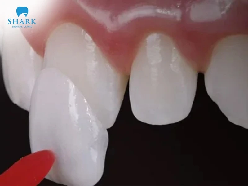 Dán sứ Veneer giúp che đi khuyết điểm, mang lại vẻ trắng sáng tự nhiên