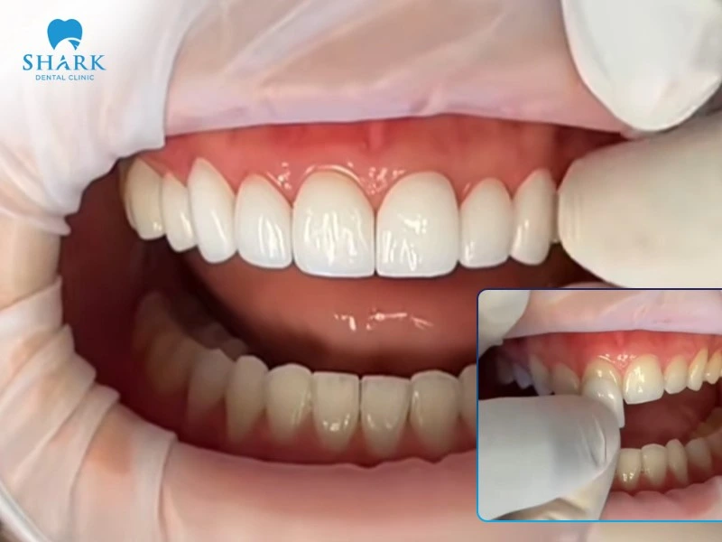 Bọc răng sứ là giải pháp an toàn để khắc phục tình trạng răng nhiễm Fluor