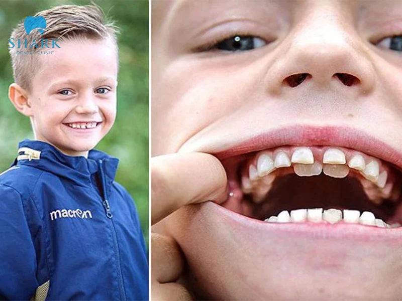 Vì sao răng sữa chưa rụng răng vĩnh viễn đã mọc? 12 Răng vĩnh viễn mọc không đúng quy trình sẽ gây lệch lạc và làm giảm tính thẩm mỹ của bé