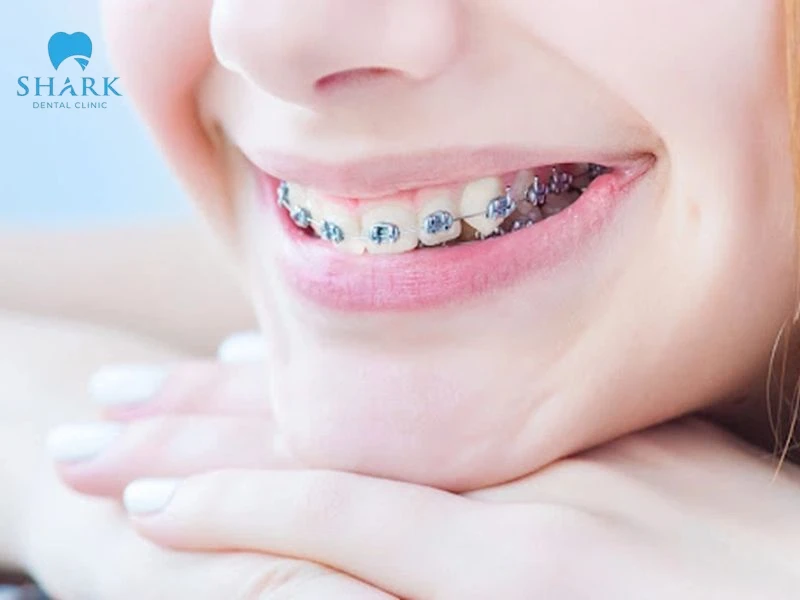 Vì sao răng sữa chưa rụng răng vĩnh viễn đã mọc? 15 Niềng răng để răng vĩnh viễn mọc lệch về đúng vị trí, giúp cải thiện hàm răng cho bé