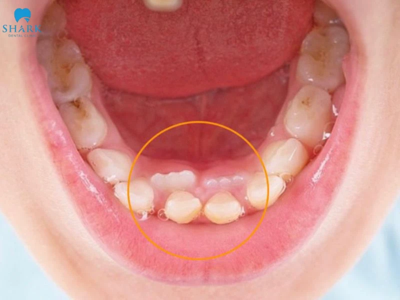 Trẻ 8 tuổi chưa thay răng sữa thì mẹ cần làm gì? 8 Thay răng chậm gây ra tình trạng răng mọc lệch, sai vị trí