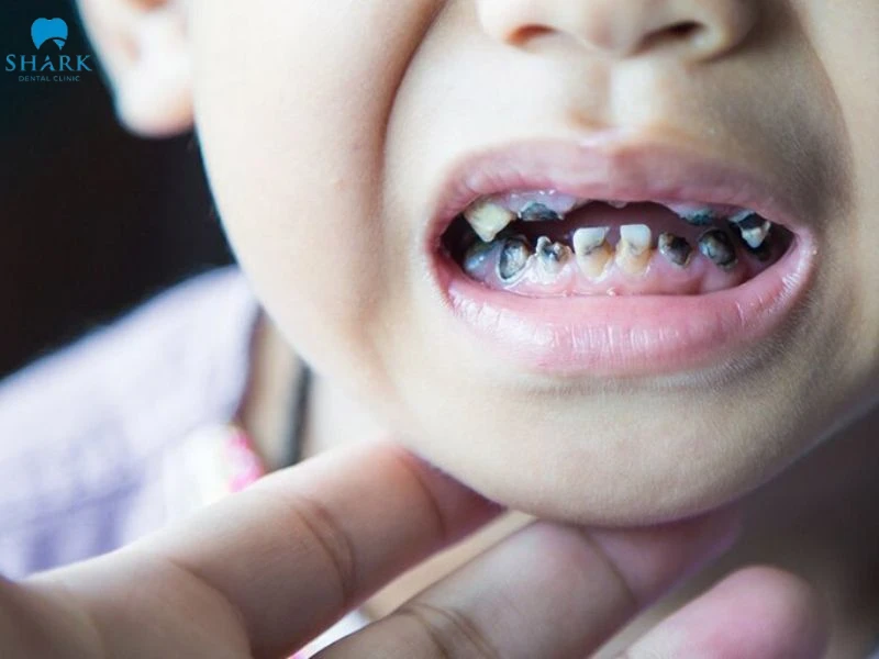 Trẻ 8 tuổi chưa thay răng sữa thì mẹ cần làm gì? 9 Trẻ mọc răng chậm có thể gây đau nhức, sâu răng và viêm nướu