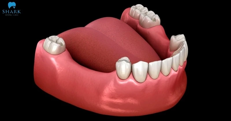 Trụ Implant Hàn Quốc thường được chỉ định cho nhiều trường hợp mất răng khác nhau
