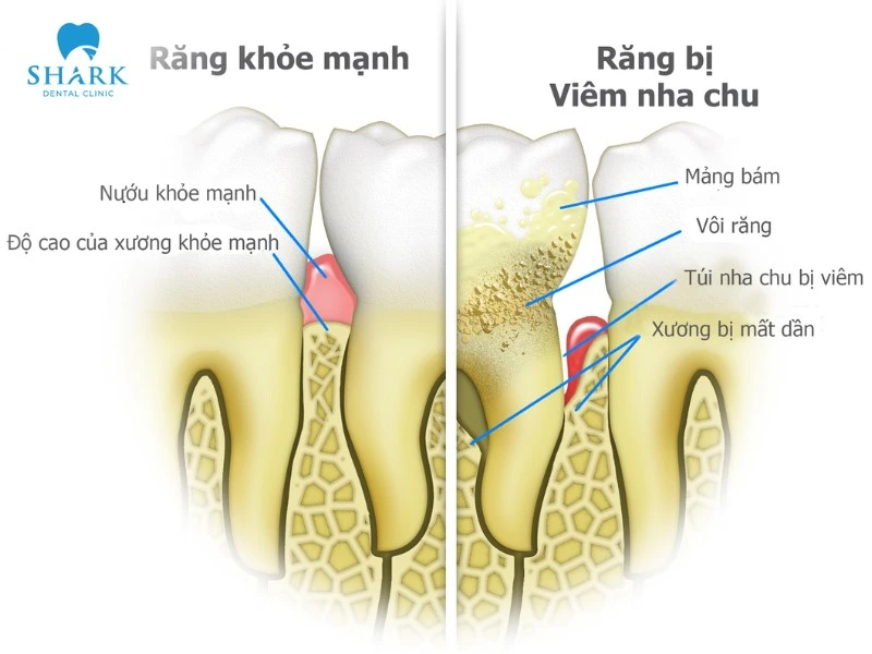 Túi nha chu là gì? Giá nạo túi nha chu bao nhiêu tiền? 9 Túi nha chu là khoảng trống hình thành giữa răng và nướu do vi khuẩn, mảng bám và vôi răng tích tụ, khiến xương nâng đỡ răng bị tiêu dần