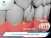 Túi nha chu là gì? Giá nạo túi nha chu bao nhiêu tiền?