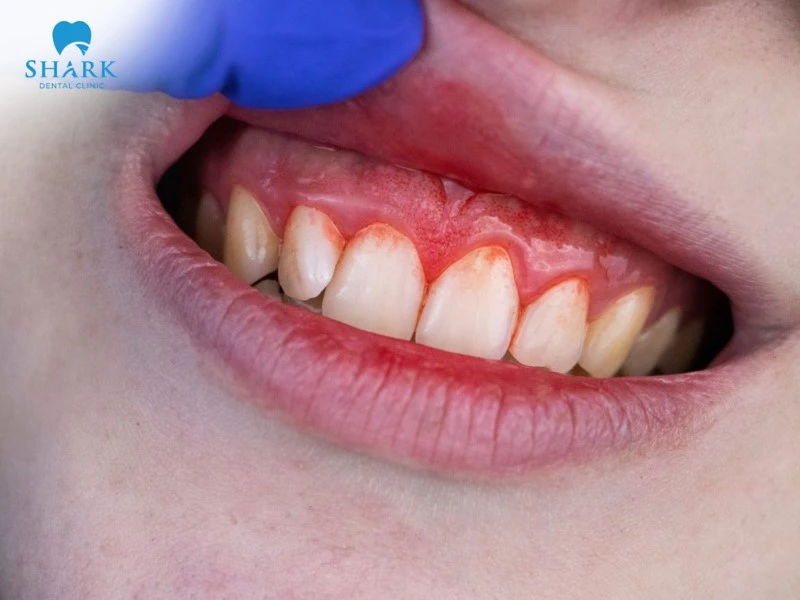 Túi nha chu là gì? Giá nạo túi nha chu bao nhiêu tiền? 10 Chảy máu chân răng là triệu chứng ban đầu của bệnh túi nha chu