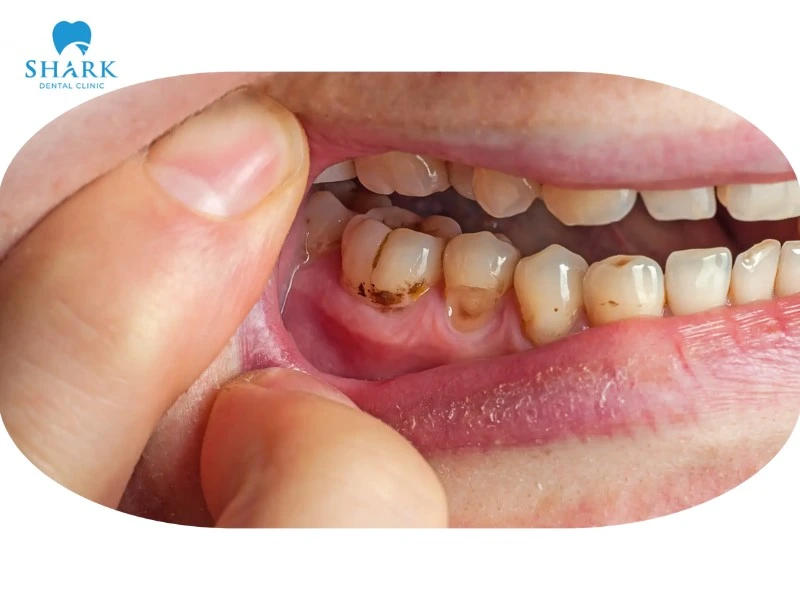 Túi nha chu là gì? Giá nạo túi nha chu bao nhiêu tiền? 11 Mảng bám trên răng tích tụ lâu ngày sẽ trở thành cao răng, tạo điều kiện cho vi khuẩn phát triển và gây viêm nhiễm nướu