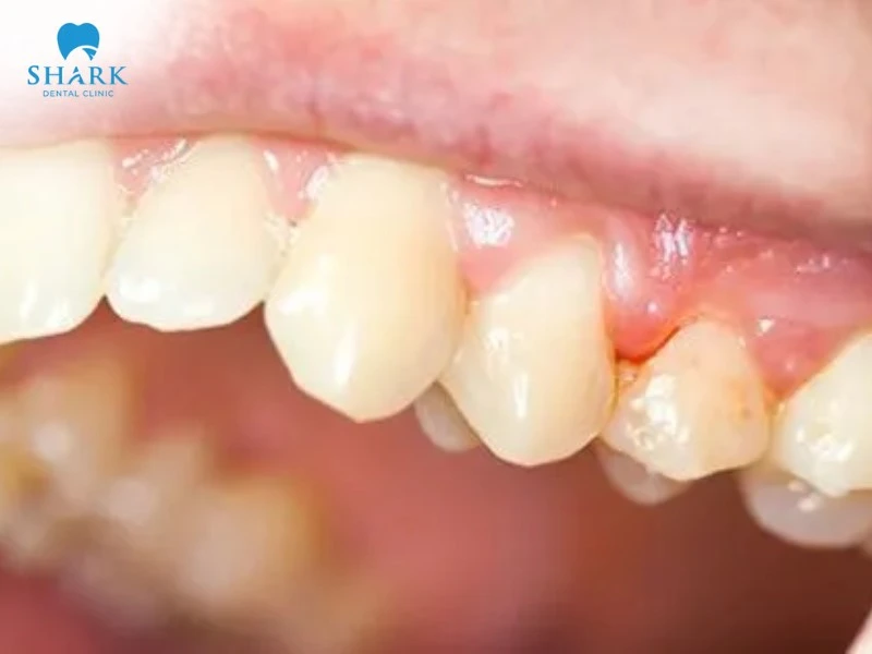 Túi nha chu là gì? Giá nạo túi nha chu bao nhiêu tiền? 12 Túi nha chu nếu không được phát hiện và điều trị kịp thời sẽ dẫn đến mất răng vĩnh viễn