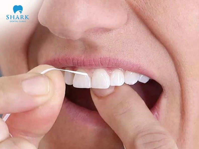 Túi nha chu là gì? Giá nạo túi nha chu bao nhiêu tiền? 15 Sử dụng chỉ nha khoa để làm sạch kẽ răng và loại bỏ mảng bám thức ăn