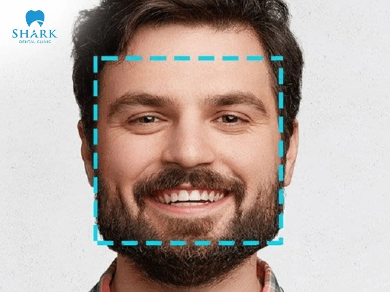 Xương quai hàm vuông