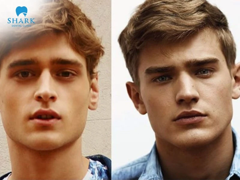 Xương quai hàm đẹp ở nam