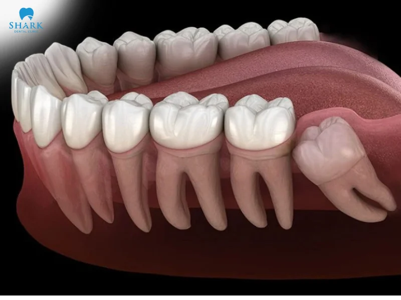 Răng khôn là răng cuối cùng trên cung hàm.