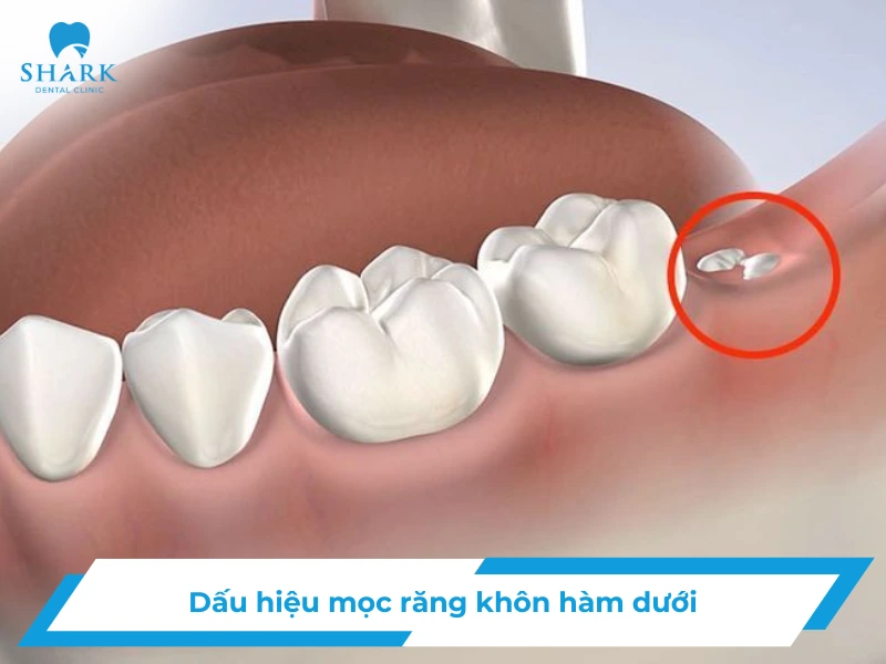 mọc răng khôn hàm dưới