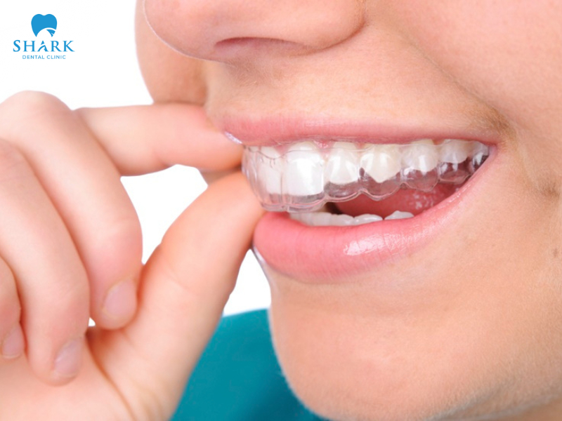 Sử dụng máng tẩy trắng răng