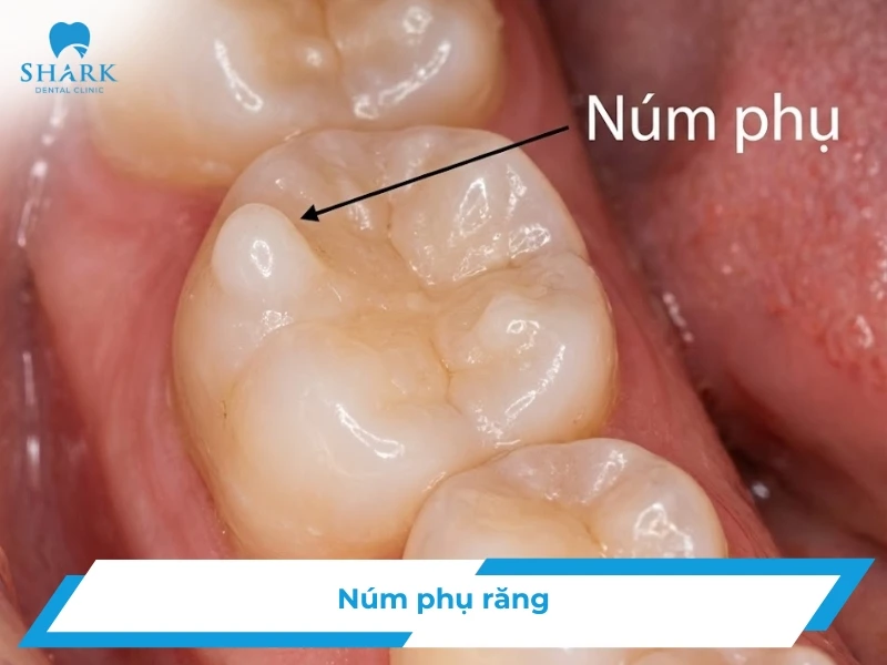 Núm phụ răng