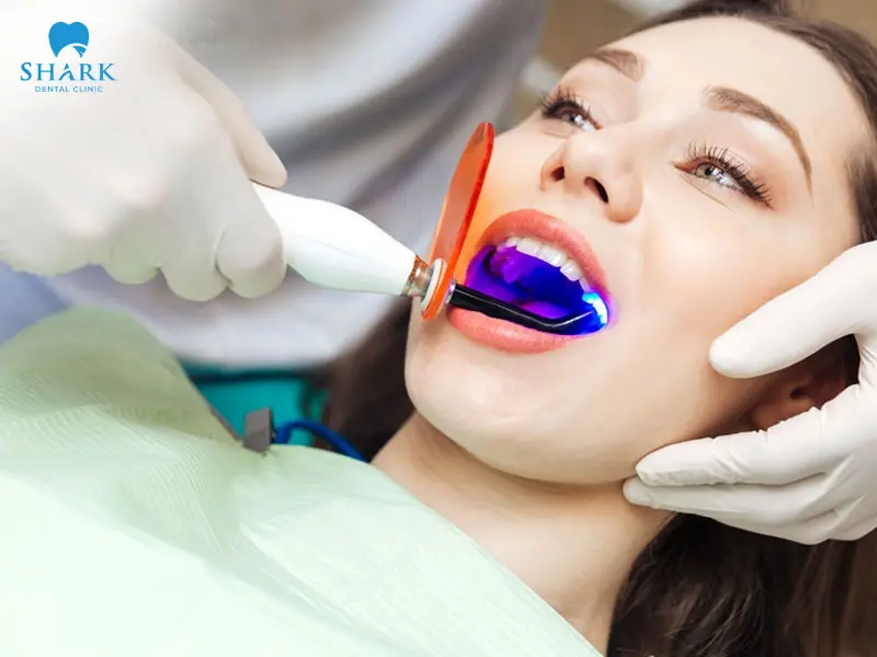 Tẩy trắng răng bằng đèn Plasma không có hại 