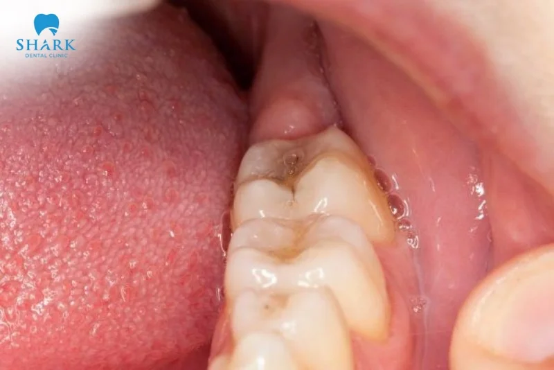 Áp xe răng khôn là gì? Nguyên nhân gây ra tình trạng này 15 áp xe răng khôn