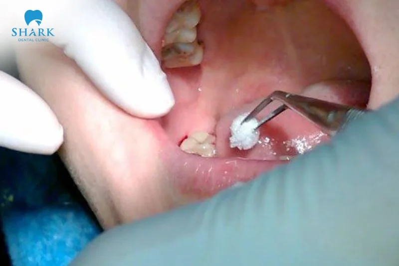 Áp xe răng khôn là gì? Nguyên nhân gây ra tình trạng này 24 vệ sinh, sát trùng vùng răng khôn