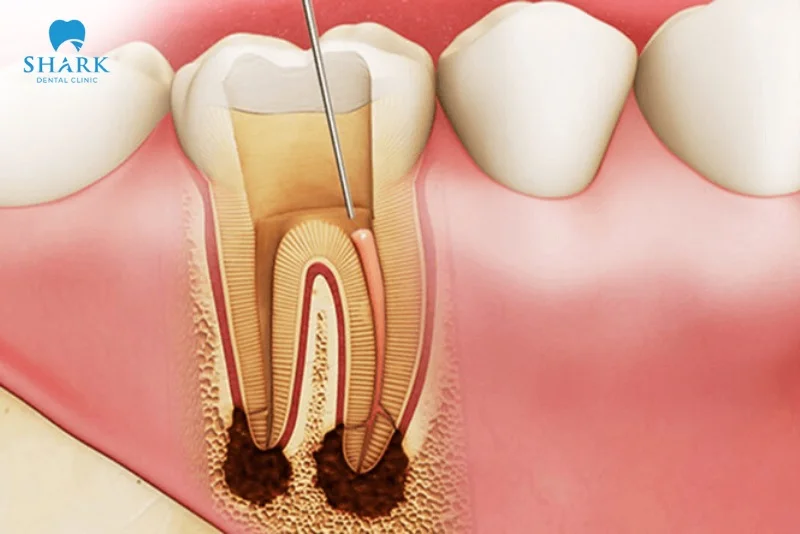 Áp xe răng khôn là gì? Nguyên nhân gây ra tình trạng này 25 răng khôn chữa tủy