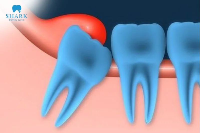Áp xe răng khôn là gì? Nguyên nhân gây ra tình trạng này 16 áp xe răng khôn gây viêm nhiễm nặng, sưng mủ