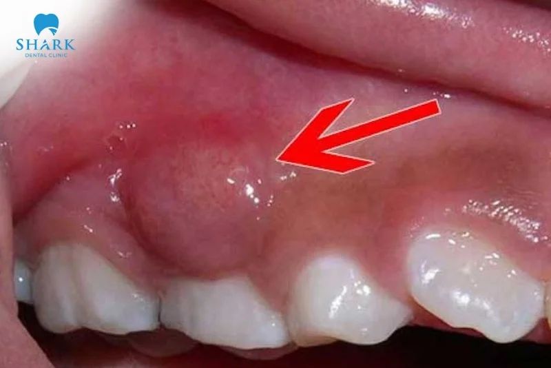 Áp xe răng khôn là gì? Nguyên nhân gây ra tình trạng này 17 áp xe nướu răng khôn