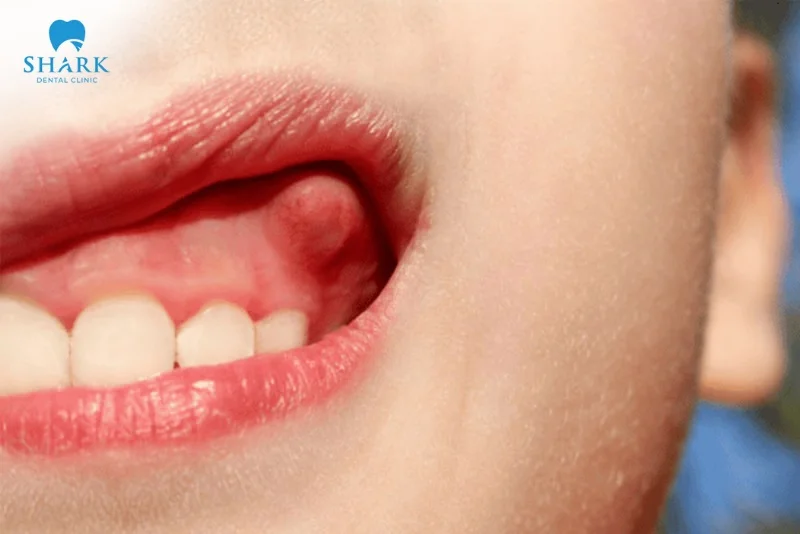 Áp xe răng khôn là gì? Nguyên nhân gây ra tình trạng này 18 áp xe nha chu răng khôn