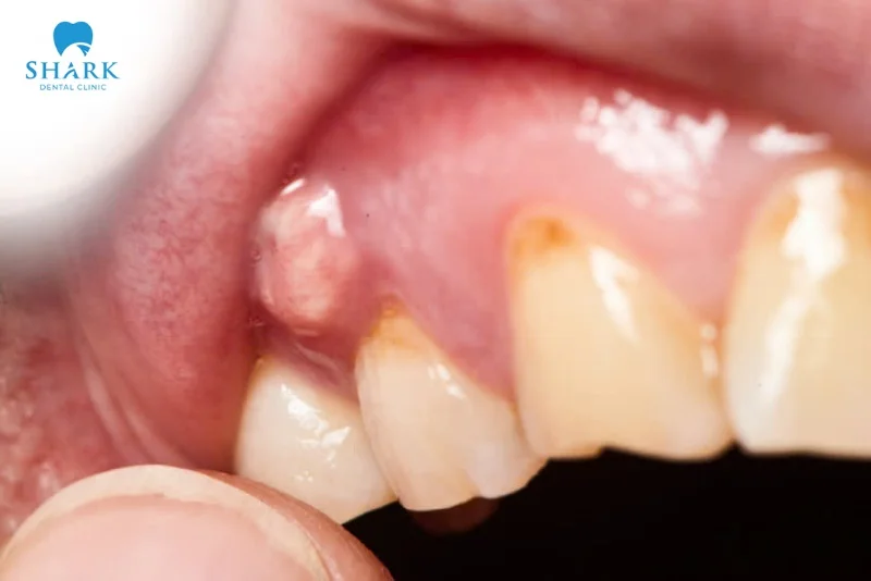 Áp xe răng khôn là gì? Nguyên nhân gây ra tình trạng này 19 áp xe quanh răng khôn