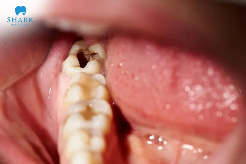 Áp xe răng khôn là gì? Nguyên nhân gây ra tình trạng này 20 răng khôn bị sâu