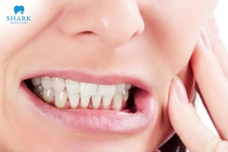 Áp xe răng khôn là gì? Nguyên nhân gây ra tình trạng này 21 thói quen nghiến răng