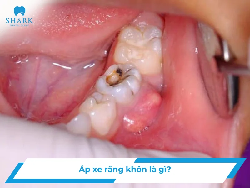 áp xe răng khôn