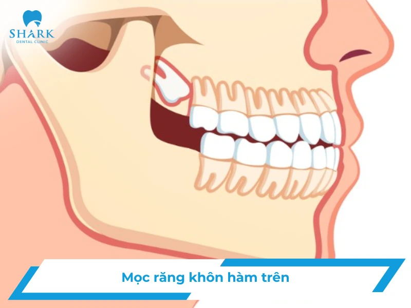 răng khôn hàm trên